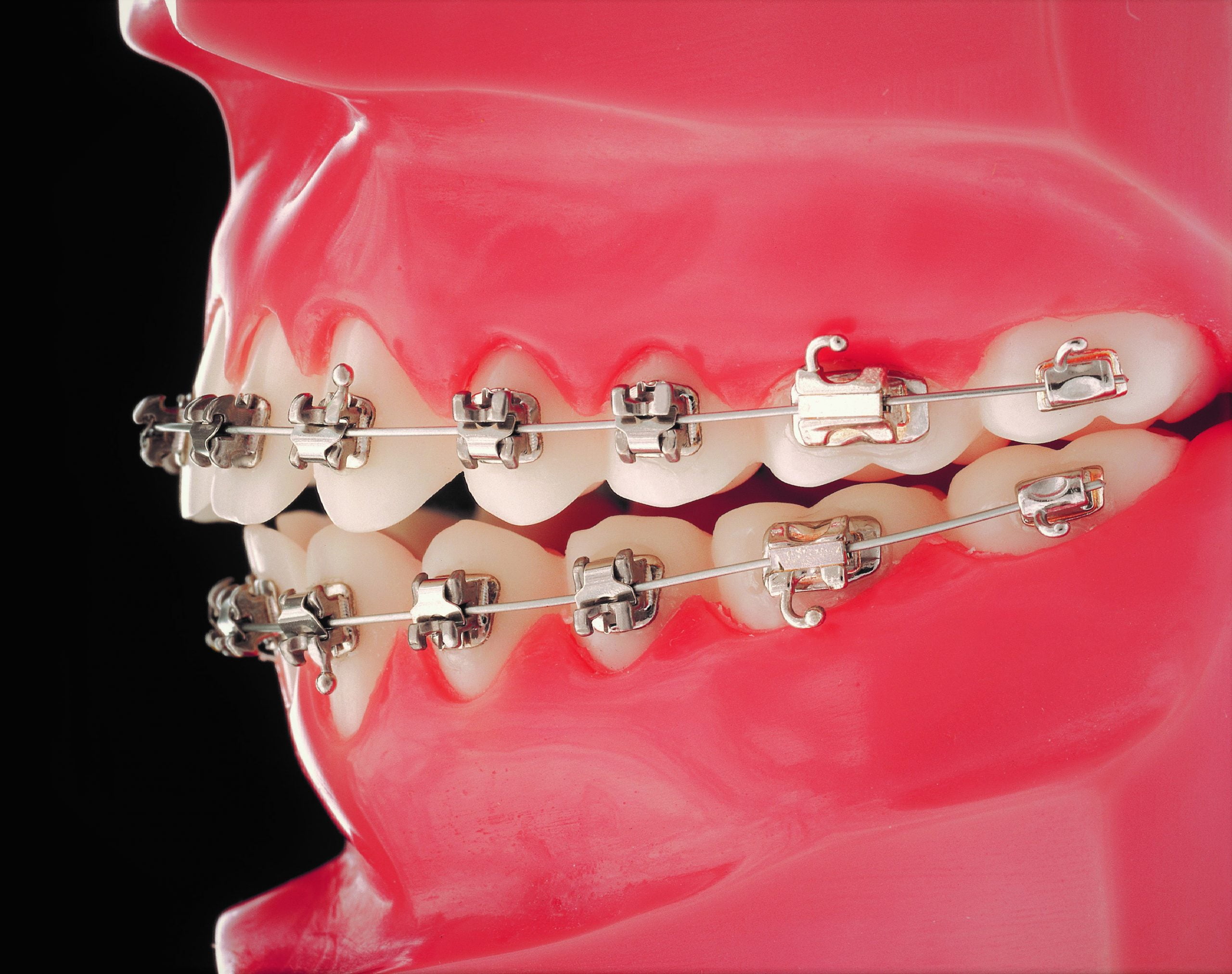 Mini Clippy SL brackets ORTHOMAX Australia