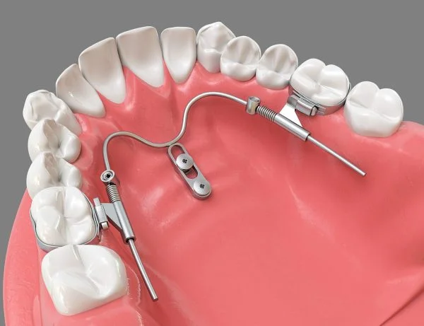 Benefit Palatal TADs - ORTHOMAX Australia