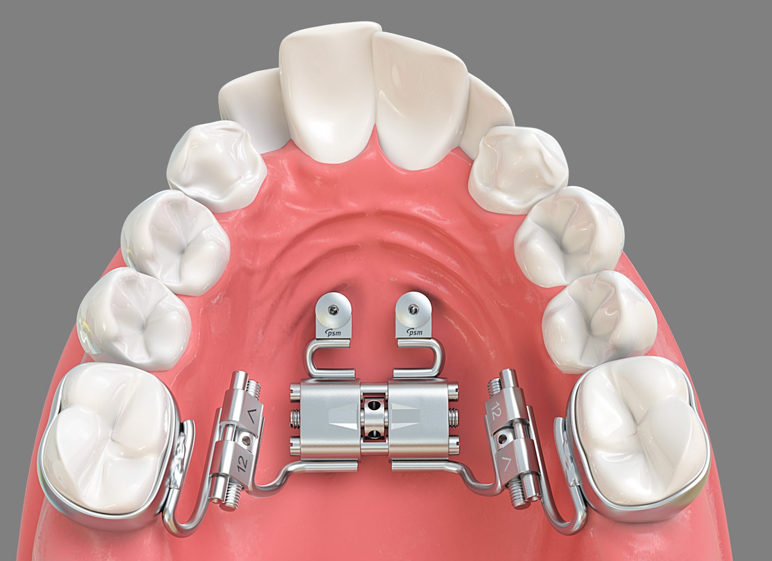 Benefit Palatal TADs ORTHOMAX Australia