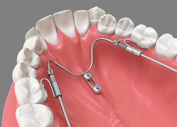 Benefit Palatal TADs - ORTHOMAX Australia