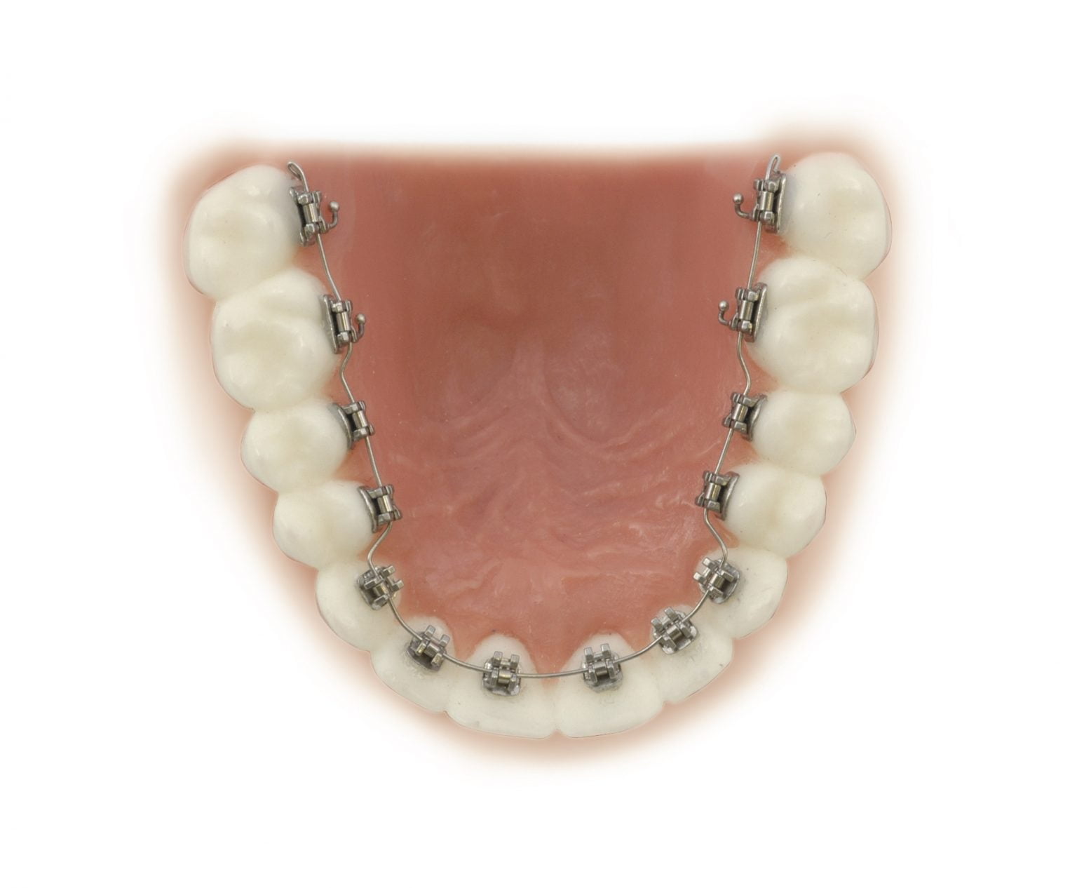 Clippy L Lingual SL Brackets ORTHOMAX Australia