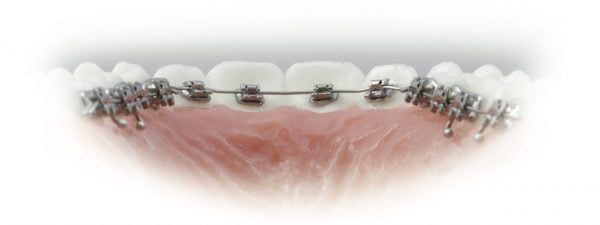 CLIPPY L LINGUAL SL BRACKETS - Image 2