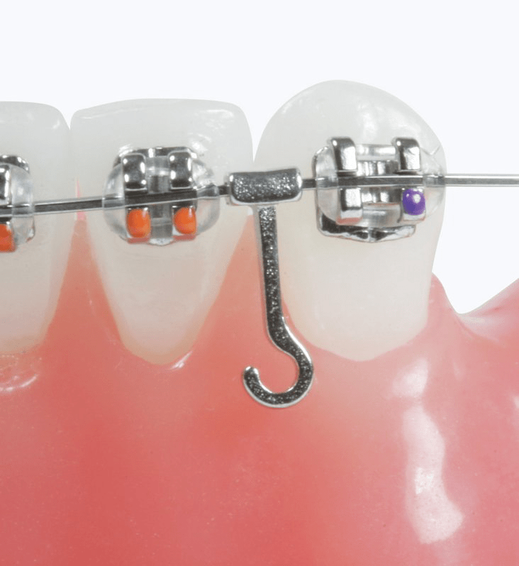 Crimpable Arch Wire Hooks ORTHOMAX Australia